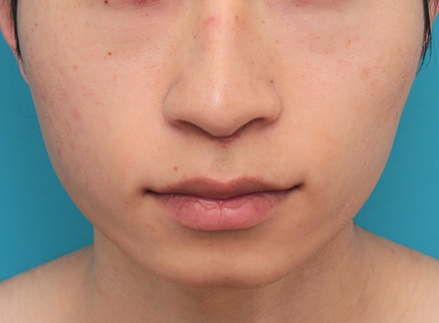 症例写真,人中短縮手術（リップリフト）で鼻の下を短くした20代男性の症例写真,3週間後,mainpic_hanashita007d.jpg
