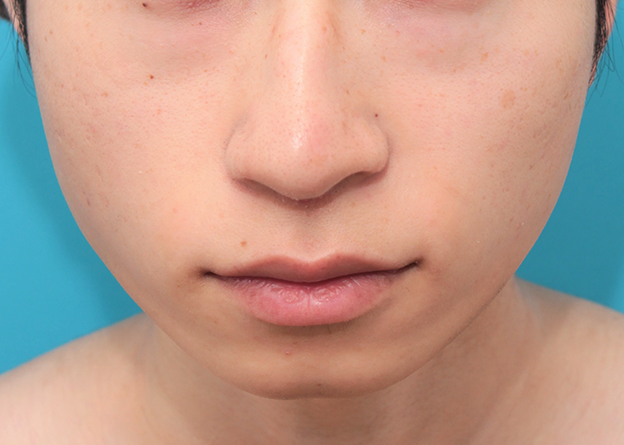鼻の下を短く（上口唇短縮手術、上口唇リフト、リップリフト、人中短縮術）,人中短縮手術（リップリフト）で鼻の下を短くした20代男性の症例写真,2ヶ月後,mainpic_hanashita007e.jpg