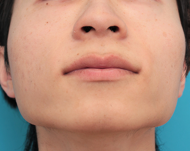 鼻の下を短く（上口唇短縮手術、上口唇リフト、リップリフト、人中短縮術）,人中短縮手術（リップリフト）で鼻の下を短くした20代男性の症例写真,手術前,mainpic_hanashita007f.jpg