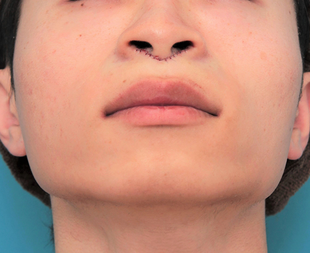 鼻の下を短く（上口唇短縮手術、上口唇リフト、リップリフト、人中短縮術）,人中短縮手術（リップリフト）で鼻の下を短くした20代男性の症例写真,手術直後,mainpic_hanashita007g.jpg