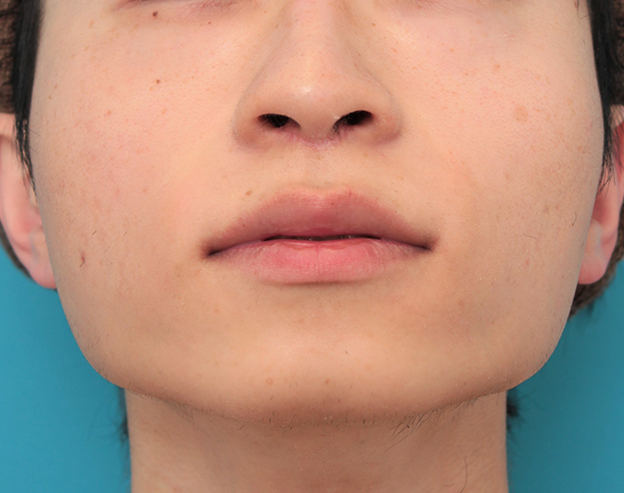鼻の下を短く（上口唇短縮手術、上口唇リフト、リップリフト、人中短縮術）,人中短縮手術（リップリフト）で鼻の下を短くした20代男性の症例写真,2ヶ月後,mainpic_hanashita007j.jpg