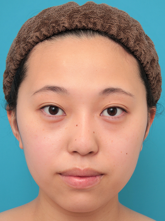 隆鼻術（シリコンプロテーゼ）,シリコンプロテーゼで鼻筋を通した20代女性の症例写真,After（6ヶ月後）,ba_ryubi1061_b01.jpg