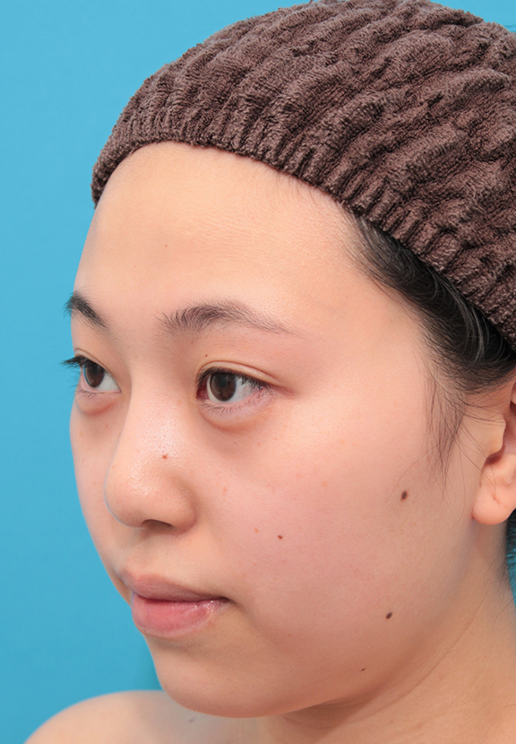 隆鼻術（シリコンプロテーゼ）,シリコンプロテーゼで鼻筋を通した20代女性の症例写真,After（6ヶ月後）,ba_ryubi1061_b02.jpg