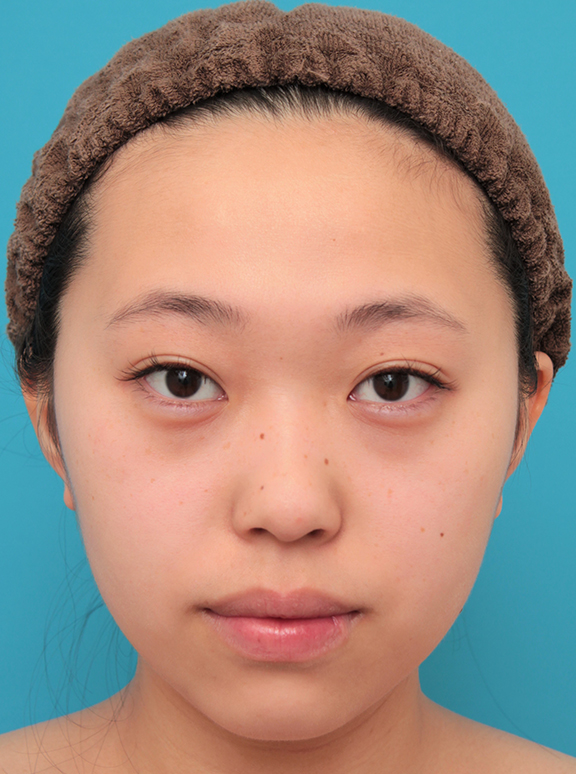 シリコンプロテーゼで鼻筋を通した20代女性の症例写真,Before,ba_ryubi1061_b01.jpg