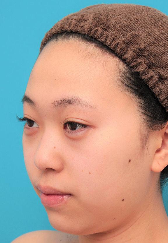 隆鼻術（シリコンプロテーゼ）,シリコンプロテーゼで鼻筋を通した20代女性の症例写真,Before,ba_ryubi1061_b02.jpg