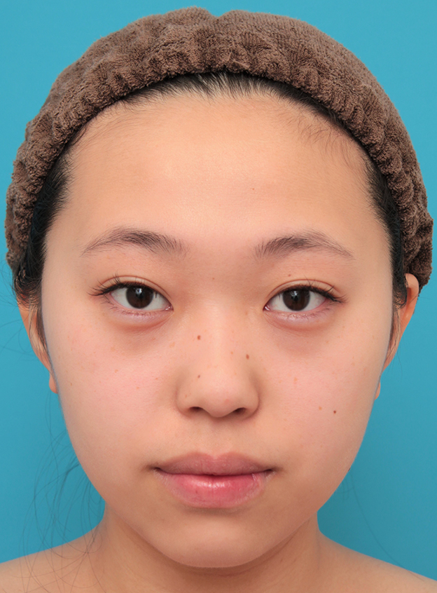 隆鼻術（シリコンプロテーゼ）,シリコンプロテーゼで鼻筋を通した20代女性の症例写真,手術前,mainpic_ryubi1061a.jpg