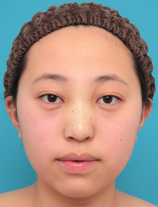隆鼻術（シリコンプロテーゼ）,シリコンプロテーゼで鼻筋を通した20代女性の症例写真,手術直後,mainpic_ryubi1061b.jpg
