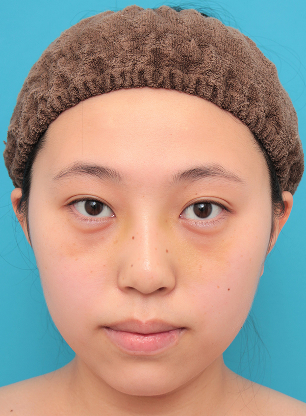 隆鼻術（シリコンプロテーゼ）,シリコンプロテーゼで鼻筋を通した20代女性の症例写真,6日後,mainpic_ryubi1061c.jpg