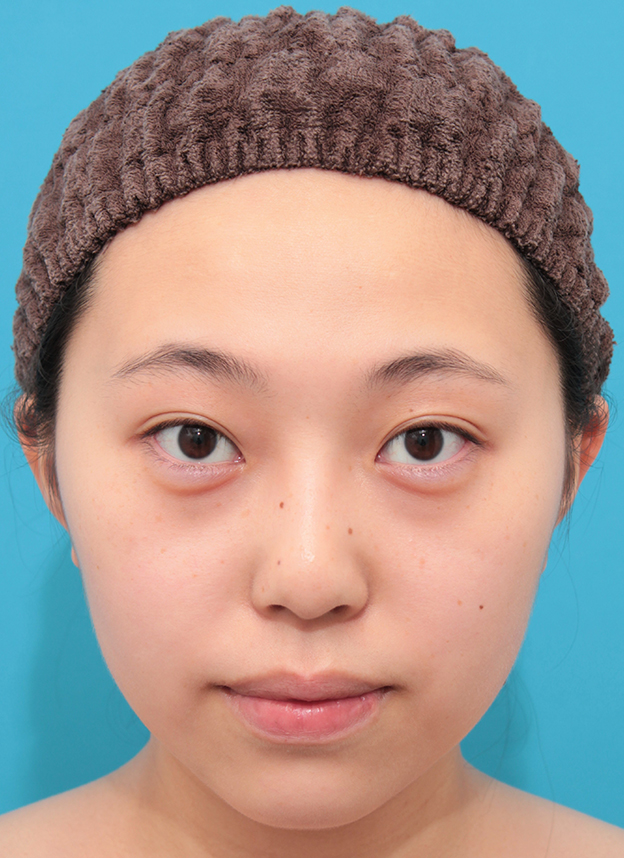 隆鼻術（シリコンプロテーゼ）,シリコンプロテーゼで鼻筋を通した20代女性の症例写真,3週間後,mainpic_ryubi1061d.jpg