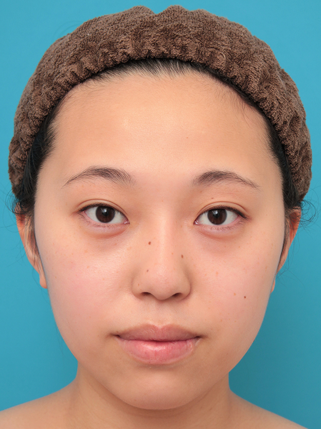 隆鼻術（シリコンプロテーゼ）,シリコンプロテーゼで鼻筋を通した20代女性の症例写真,6ヶ月後,mainpic_ryubi1061e.jpg