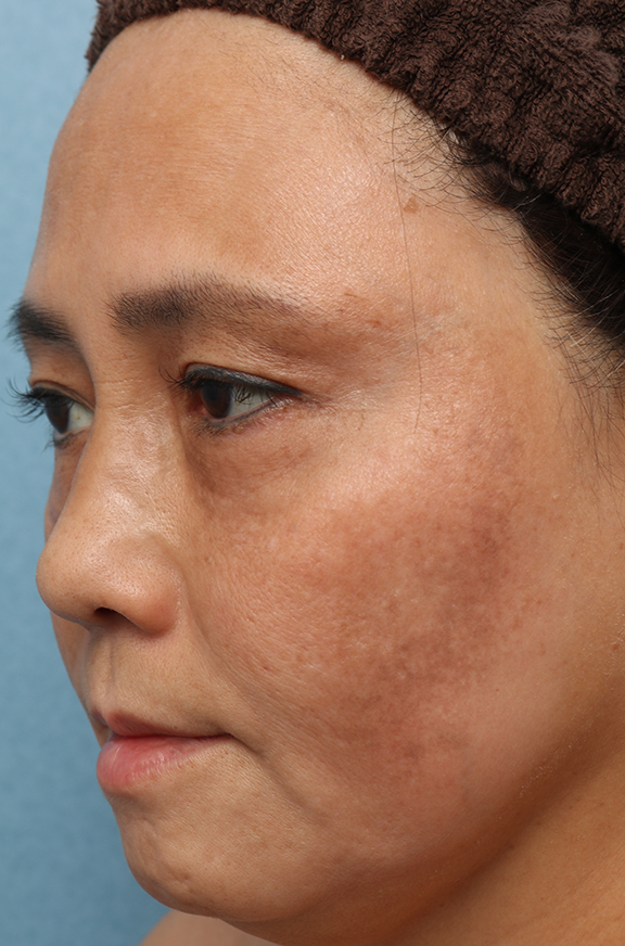 他院で受けた手術の修正（美容皮膚科）,他院でのレーザー治療で悪化したシミ治療の症例,After（5ヶ月後）,ba_tore_hydro005_b02.jpg