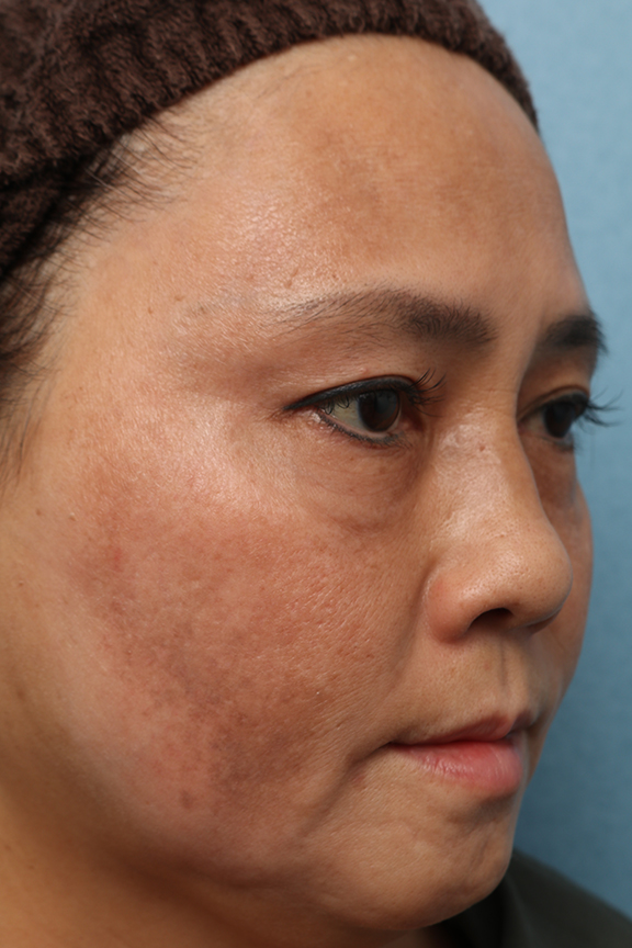 他院で受けた手術の修正（美容皮膚科）,他院でのレーザー治療で悪化したシミ治療の症例,After（5ヶ月後）,ba_tore_hydro005_b03.jpg