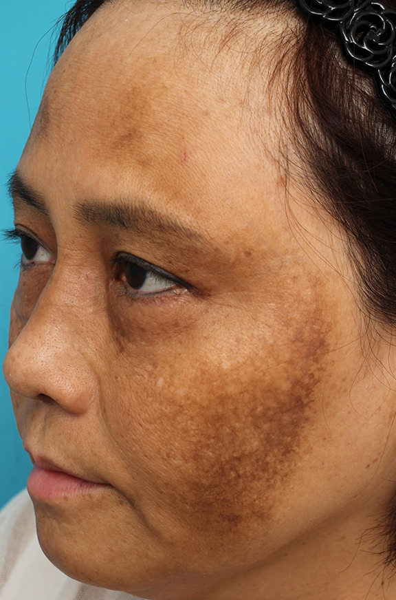 他院で受けた手術の修正（美容皮膚科）,他院でのレーザー治療で悪化したシミ治療の症例,Before,ba_tore_hydro005_b02.jpg