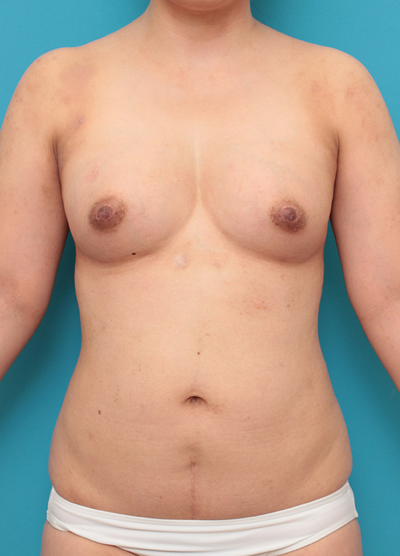 脂肪吸引,お腹周りから脂肪吸引し、バストに脂肪注入した30代女性の症例写真,After（7ヶ月後）,ba_shibokyuin046_b01.jpg