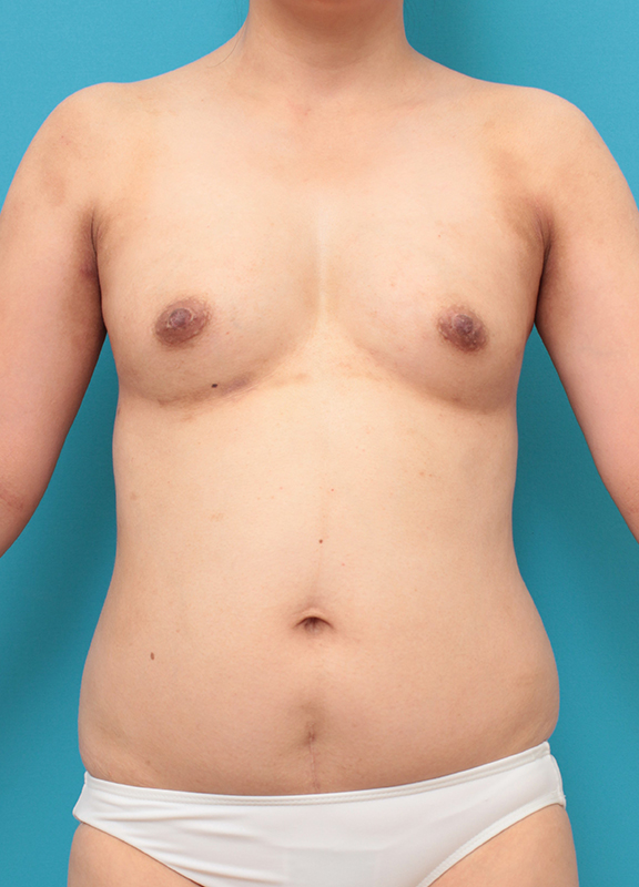 脂肪吸引,ピュアコンデンス脂肪注入豊胸,お腹周りから脂肪吸引し、バストに脂肪注入した30代女性の症例写真,Before,ba_shibokyuin046_b01.jpg