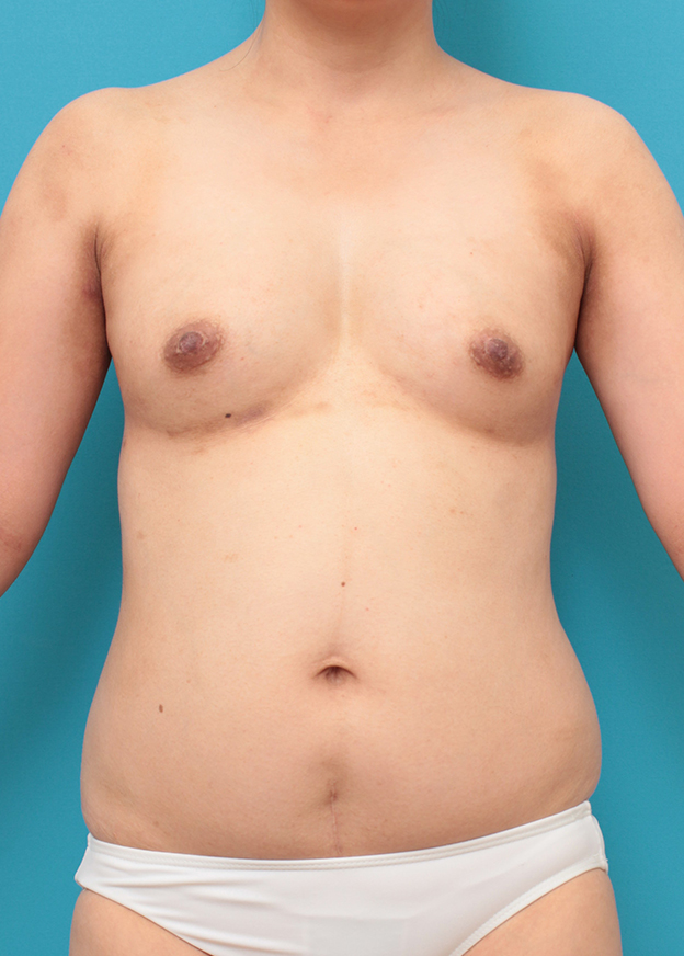 ピュアコンデンス脂肪注入豊胸,お腹周りから脂肪吸引し、バストに脂肪注入した30代女性の症例写真,手術前,mainpic_shibokyuin046a.jpg