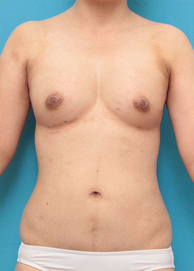 ピュアコンデンス脂肪注入豊胸,お腹周りから脂肪吸引し、バストに脂肪注入した30代女性の症例写真,3週間後,mainpic_shibokyuin046d.jpg