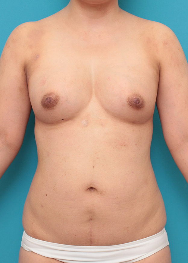 ピュアコンデンス脂肪注入豊胸,お腹周りから脂肪吸引し、バストに脂肪注入した30代女性の症例写真,7ヶ月後,mainpic_shibokyuin046f.jpg