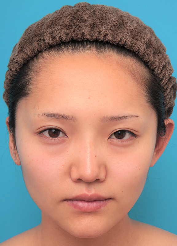 耳介軟骨移植（鼻先を出す）,鼻筋の長期持続型ヒアルロン酸+鼻先の耳介軟骨移植を行った20代女性の症例写真,After（2ヶ月後）,ba_ryubi2041_b01.jpg