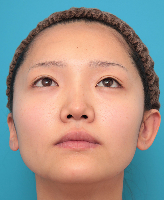 隆鼻注射（ヒアルロン酸注射）,鼻筋の長期持続型ヒアルロン酸+鼻先の耳介軟骨移植を行った20代女性の症例写真,After（2ヶ月後）,ba_ryubi2041_b03.jpg