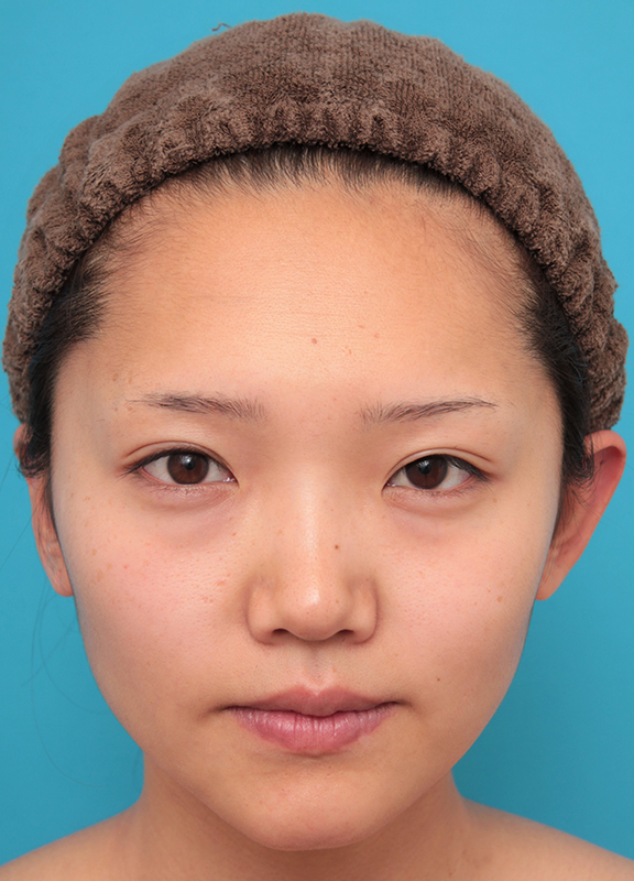 耳介軟骨移植（鼻先を出す）,鼻筋の長期持続型ヒアルロン酸+鼻先の耳介軟骨移植を行った20代女性の症例写真,Before,ba_ryubi2041_b01.jpg