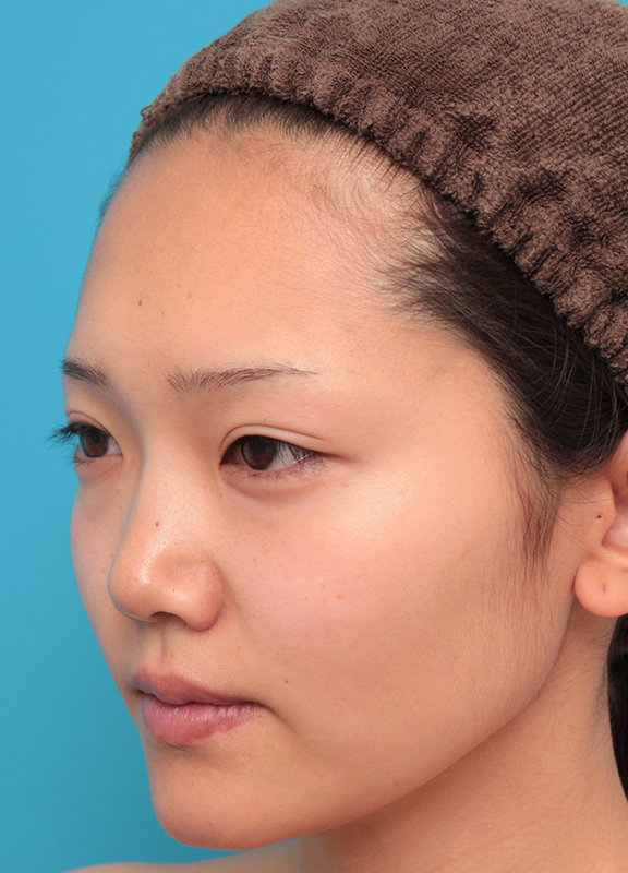 隆鼻注射（ヒアルロン酸注射）,鼻筋の長期持続型ヒアルロン酸+鼻先の耳介軟骨移植を行った20代女性の症例写真,Before,ba_ryubi2041_b02.jpg