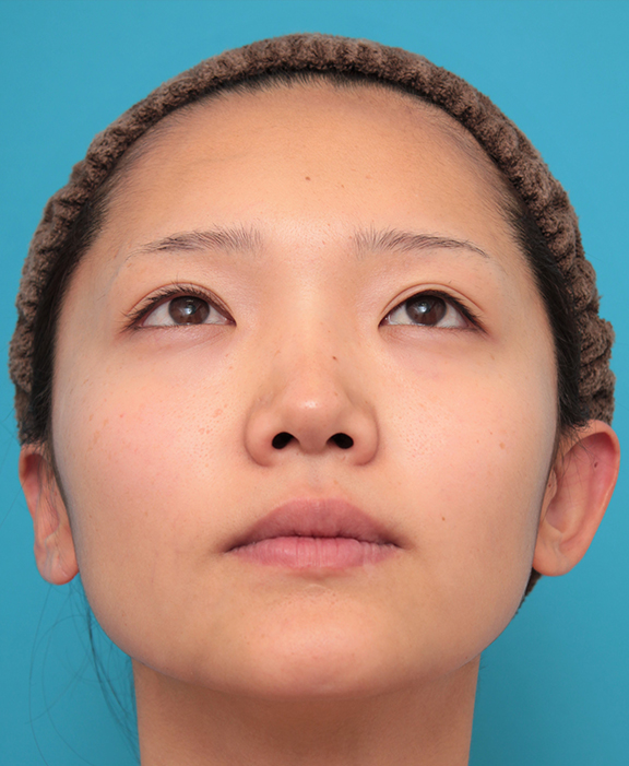 隆鼻注射（ヒアルロン酸注射）,鼻筋の長期持続型ヒアルロン酸+鼻先の耳介軟骨移植を行った20代女性の症例写真,Before,ba_ryubi2041_b03.jpg