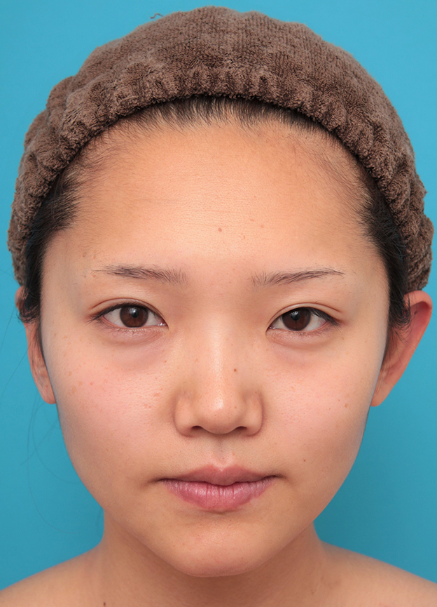 隆鼻注射（ヒアルロン酸注射）,鼻筋の長期持続型ヒアルロン酸+鼻先の耳介軟骨移植を行った20代女性の症例写真,治療前,mainpic_ryubi2041a.jpg
