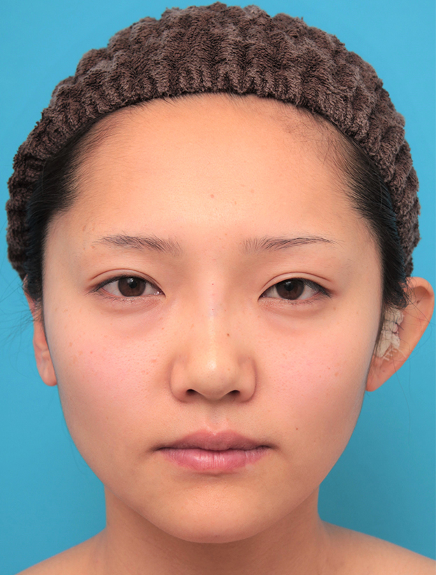 耳介軟骨移植（鼻先を出す）,鼻筋の長期持続型ヒアルロン酸+鼻先の耳介軟骨移植を行った20代女性の症例写真,治療直後,mainpic_ryubi2041b.jpg