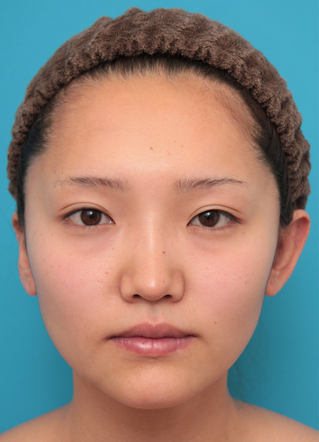 隆鼻注射（ヒアルロン酸注射）,鼻筋の長期持続型ヒアルロン酸+鼻先の耳介軟骨移植を行った20代女性の症例写真,6日後,mainpic_ryubi2041c.jpg
