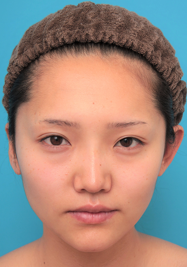 隆鼻注射（ヒアルロン酸注射）,鼻筋の長期持続型ヒアルロン酸+鼻先の耳介軟骨移植を行った20代女性の症例写真,2ヶ月後,mainpic_ryubi2041d.jpg