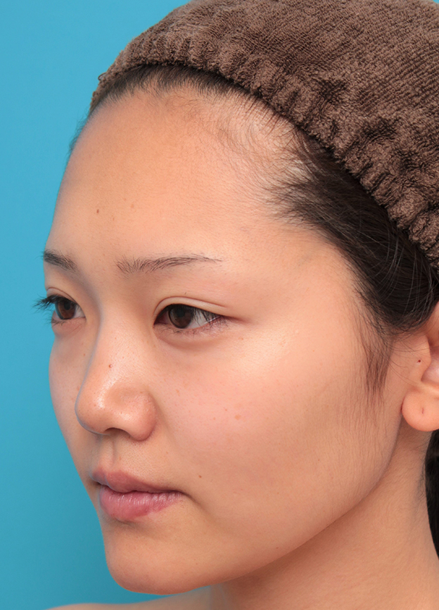 耳介軟骨移植（鼻先を出す）,鼻筋の長期持続型ヒアルロン酸+鼻先の耳介軟骨移植を行った20代女性の症例写真,治療前,mainpic_ryubi2041e.jpg