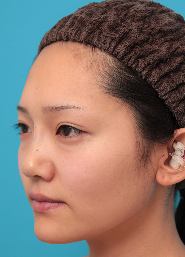 耳介軟骨移植（鼻先を出す）,鼻筋の長期持続型ヒアルロン酸+鼻先の耳介軟骨移植を行った20代女性の症例写真,治療直後,mainpic_ryubi2041f.jpg