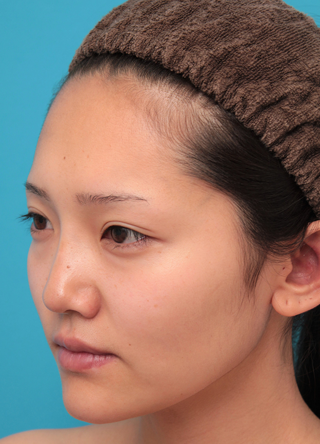 耳介軟骨移植（鼻先を出す）,鼻筋の長期持続型ヒアルロン酸+鼻先の耳介軟骨移植を行った20代女性の症例写真,6日後,mainpic_ryubi2041g.jpg