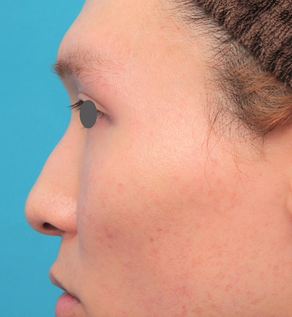 耳介軟骨移植（鼻先を出す）,鼻骨切り幅寄せ+小鼻縮小+鼻尖縮小+鼻先の耳介軟骨移植を行った20代男性の症例写真,Before,ba_honekiri011_b03.jpg