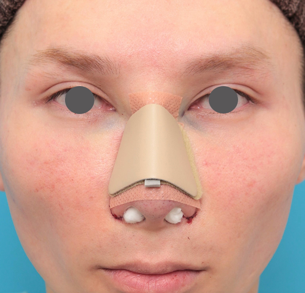 骨切幅寄せ（鼻の根元を細く）,鼻骨切り幅寄せ+小鼻縮小+鼻尖縮小+鼻先の耳介軟骨移植を行った20代男性の症例写真,手術直後,mainpic_honekiri011b.jpg