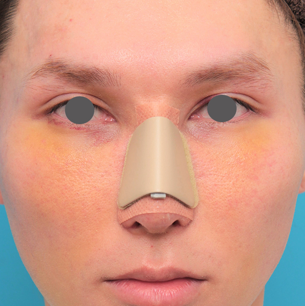 症例写真,鼻骨切り幅寄せ+小鼻縮小+鼻尖縮小+鼻先の耳介軟骨移植を行った20代男性の症例写真,1週間後,mainpic_honekiri011c.jpg