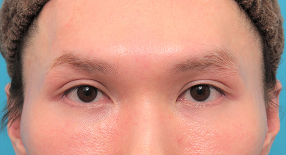 目尻切開,垂れ目（パンダ目）形成（グラマラスライン／下眼瞼下制術）,目尻切開+グラマラスラインを行った20代男性の症例写真,After（6ヶ月後）,ba_mejiri024_a01.jpg