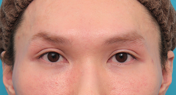 目尻切開,垂れ目（パンダ目）形成（グラマラスライン／下眼瞼下制術）,目尻切開+グラマラスラインを行った20代男性の症例写真,Before,ba_mejiri024_b01.jpg
