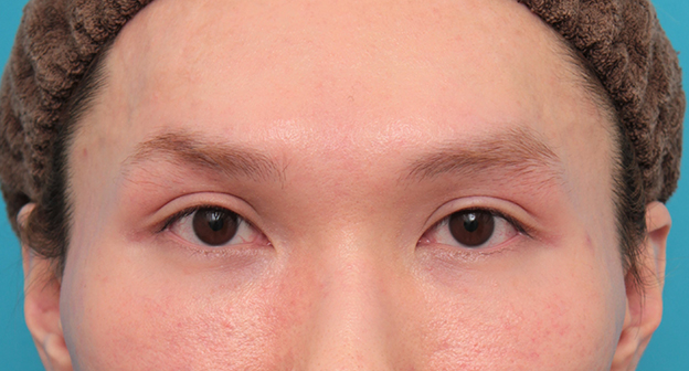 垂れ目（パンダ目）形成（グラマラスライン／下眼瞼下制術）,目尻切開+グラマラスラインを行った20代男性の症例写真,手術前,mainpic_mejiri024a.jpg