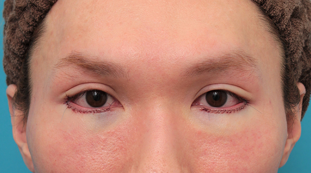 垂れ目（パンダ目）形成（グラマラスライン／下眼瞼下制術）,目尻切開+グラマラスラインを行った20代男性の症例写真,手術直後,mainpic_mejiri024b.jpg