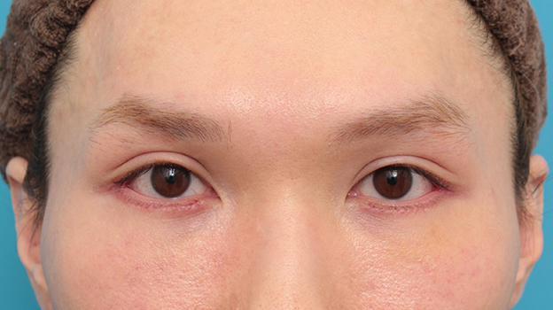 垂れ目（パンダ目）形成（グラマラスライン／下眼瞼下制術）,目尻切開+グラマラスラインを行った20代男性の症例写真,6日後,mainpic_mejiri024c.jpg