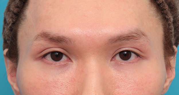 垂れ目（パンダ目）形成（グラマラスライン／下眼瞼下制術）,目尻切開+グラマラスラインを行った20代男性の症例写真,3週間後,mainpic_mejiri024d.jpg