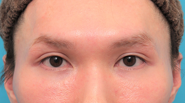 垂れ目（パンダ目）形成（グラマラスライン／下眼瞼下制術）,目尻切開+グラマラスラインを行った20代男性の症例写真,6ヶ月後,mainpic_mejiri024e.jpg