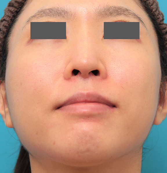 鼻の下を短く（上口唇短縮手術、上口唇リフト、リップリフト、人中短縮術）,小鼻縮小と人中短縮を同時に行った30代女性の症例写真,After（6ヶ月後）,ba_biyoku053_b02.jpg