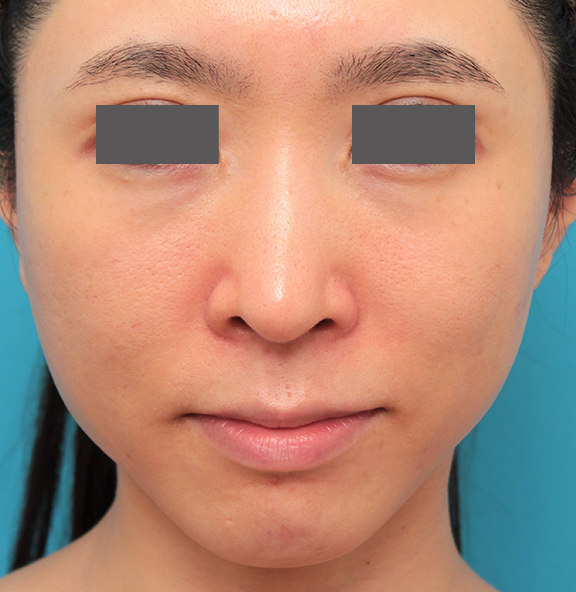 鼻の下を短く（上口唇短縮手術、上口唇リフト、リップリフト、人中短縮術）,小鼻縮小と人中短縮を同時に行った30代女性の症例写真,Before,ba_biyoku053_b01.jpg