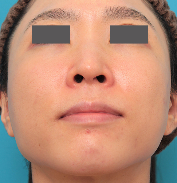 鼻の下を短く（上口唇短縮手術、上口唇リフト、リップリフト、人中短縮術）,小鼻縮小と人中短縮を同時に行った30代女性の症例写真,Before,ba_biyoku053_b02.jpg