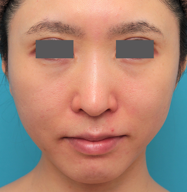 鼻の下を短く（上口唇短縮手術、上口唇リフト、リップリフト、人中短縮術）,小鼻縮小と人中短縮を同時に行った30代女性の症例写真,2ヶ月後,mainpic_biyoku053e.jpg