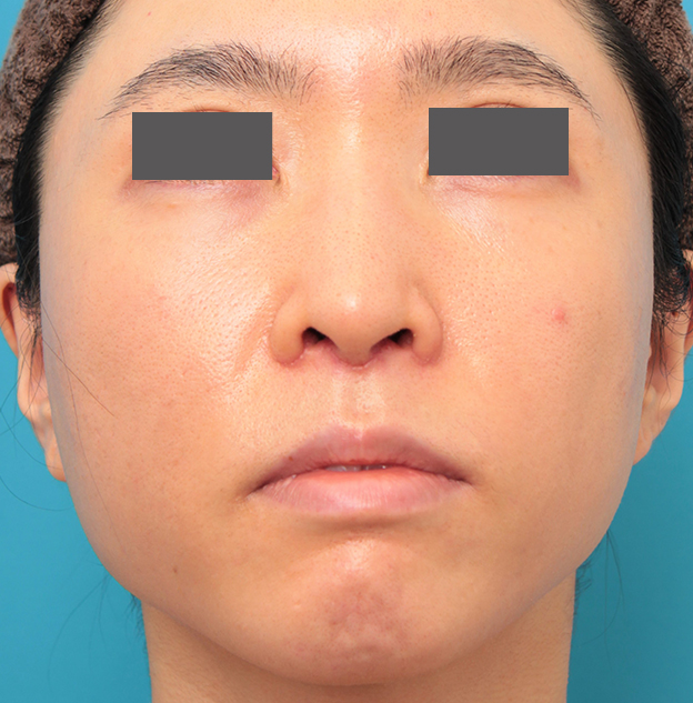 症例写真,小鼻縮小と人中短縮を同時に行った30代女性の症例写真,6日後,mainpic_biyoku053i.jpg