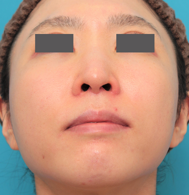 鼻の下を短く（上口唇短縮手術、上口唇リフト、リップリフト、人中短縮術）,小鼻縮小と人中短縮を同時に行った30代女性の症例写真,2ヶ月後,mainpic_biyoku053k.jpg